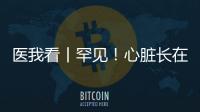 医我看丨罕见！心脏长在右胸膛�！珠海成功开展首例“右位心”房颤射频消融术